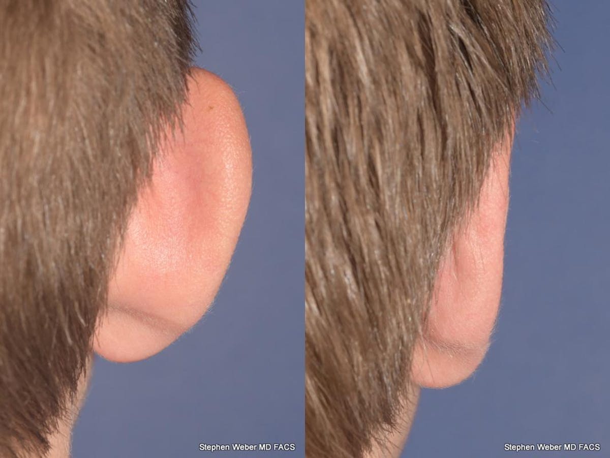 Otoplasty Before & After Gallery - Patient 294886 - Image 8