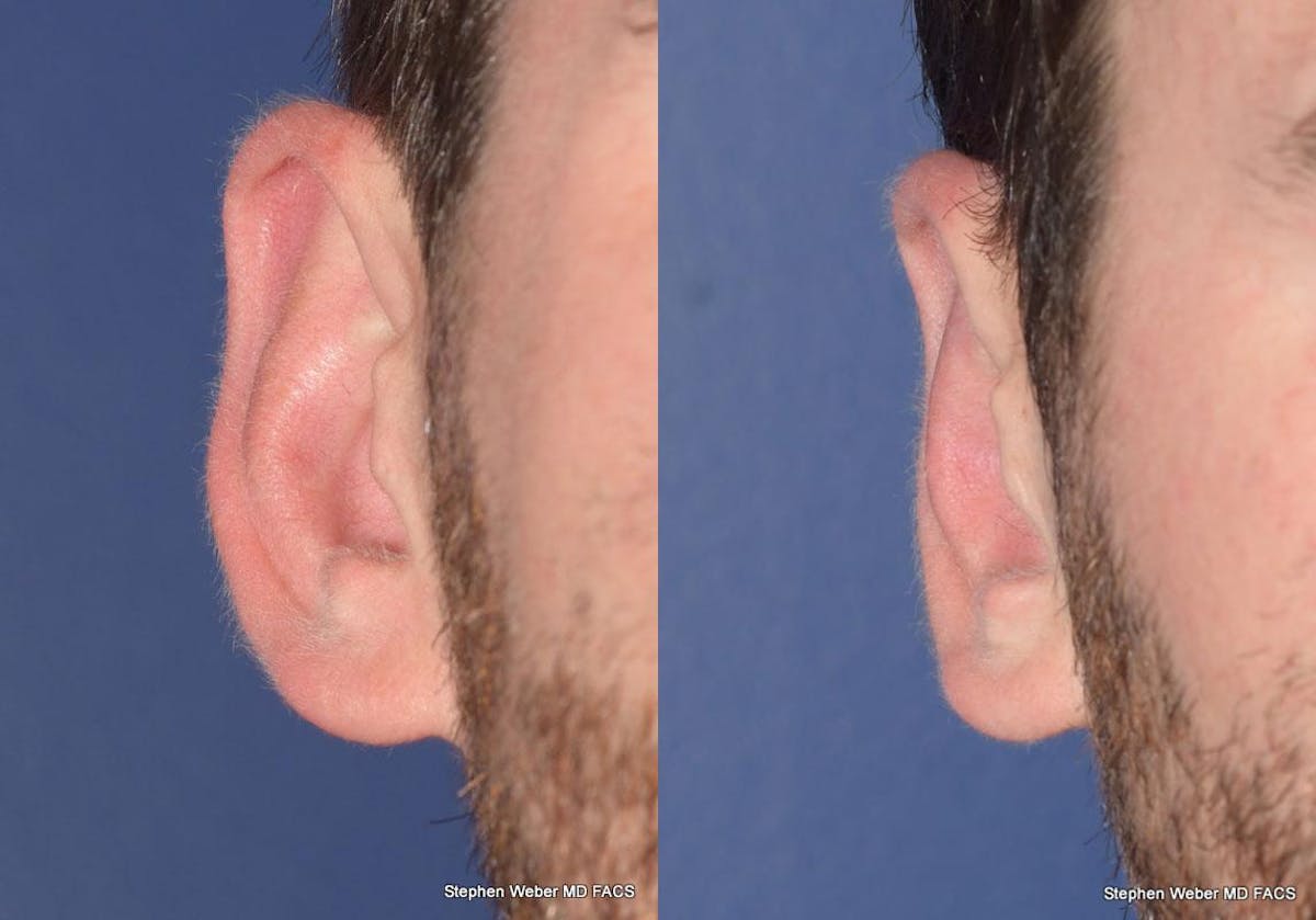 Otoplasty Before & After Gallery - Patient 344900 - Image 1