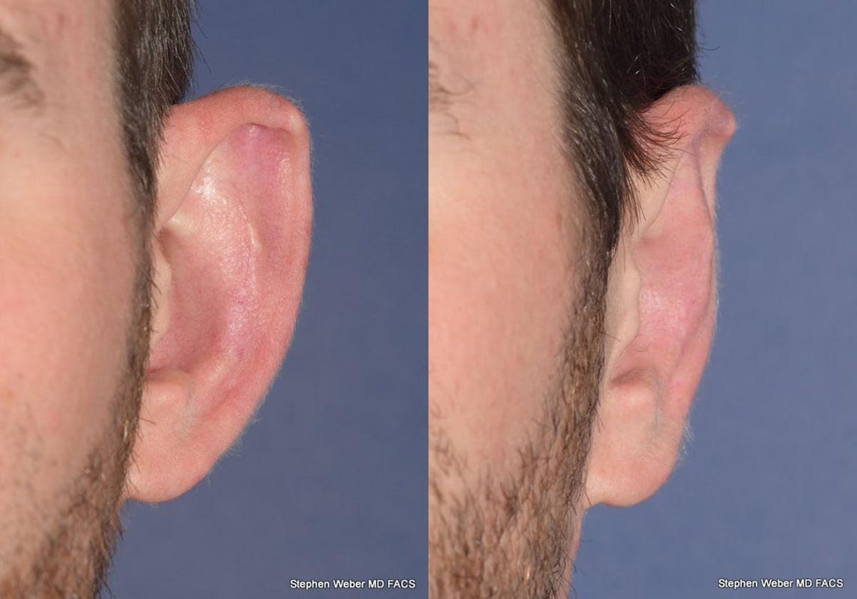 Otoplasty Before & After Gallery - Patient 344900 - Image 2