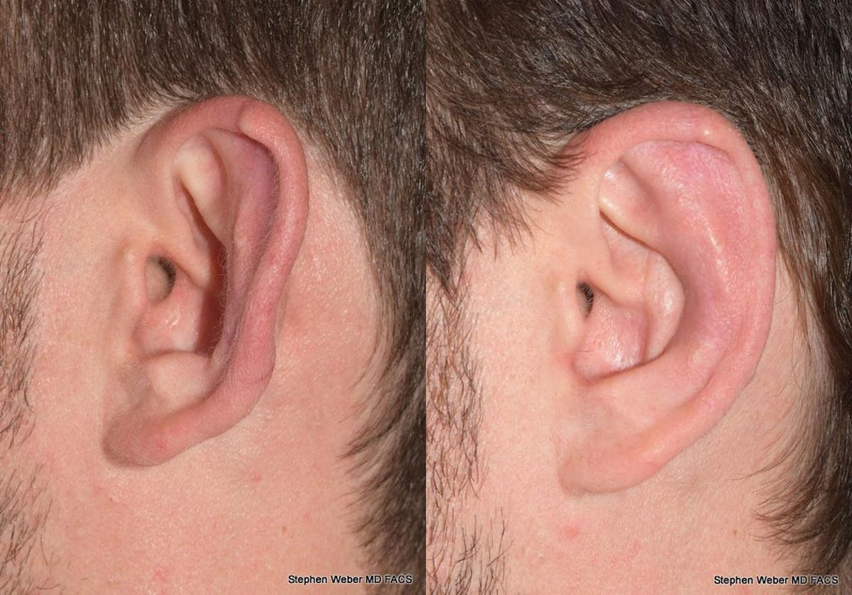 Otoplasty Before & After Gallery - Patient 344900 - Image 3