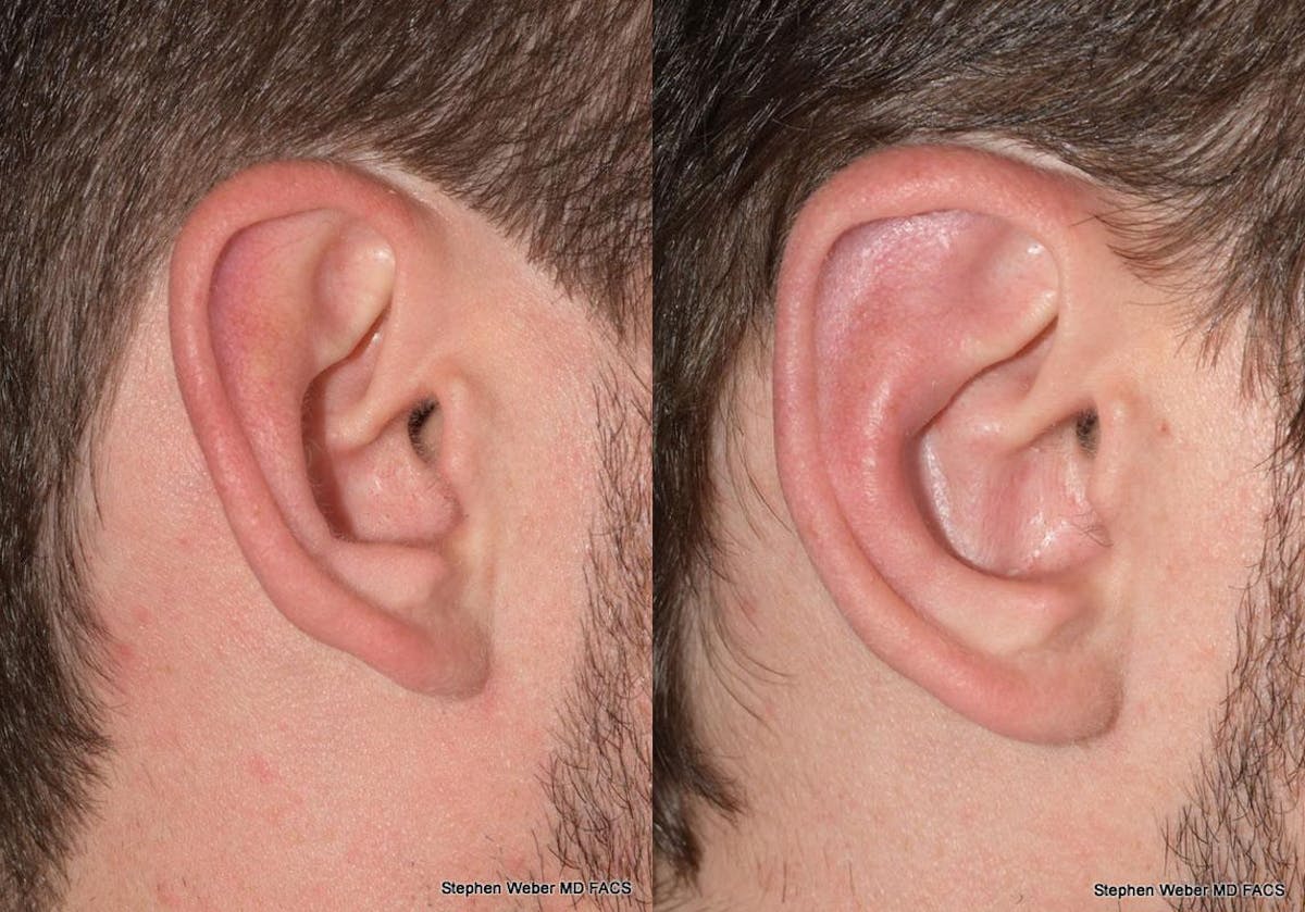 Otoplasty Before & After Gallery - Patient 344900 - Image 4