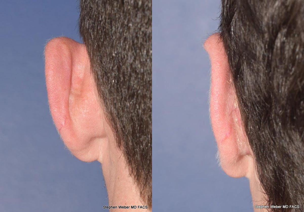 Otoplasty Before & After Gallery - Patient 344900 - Image 5