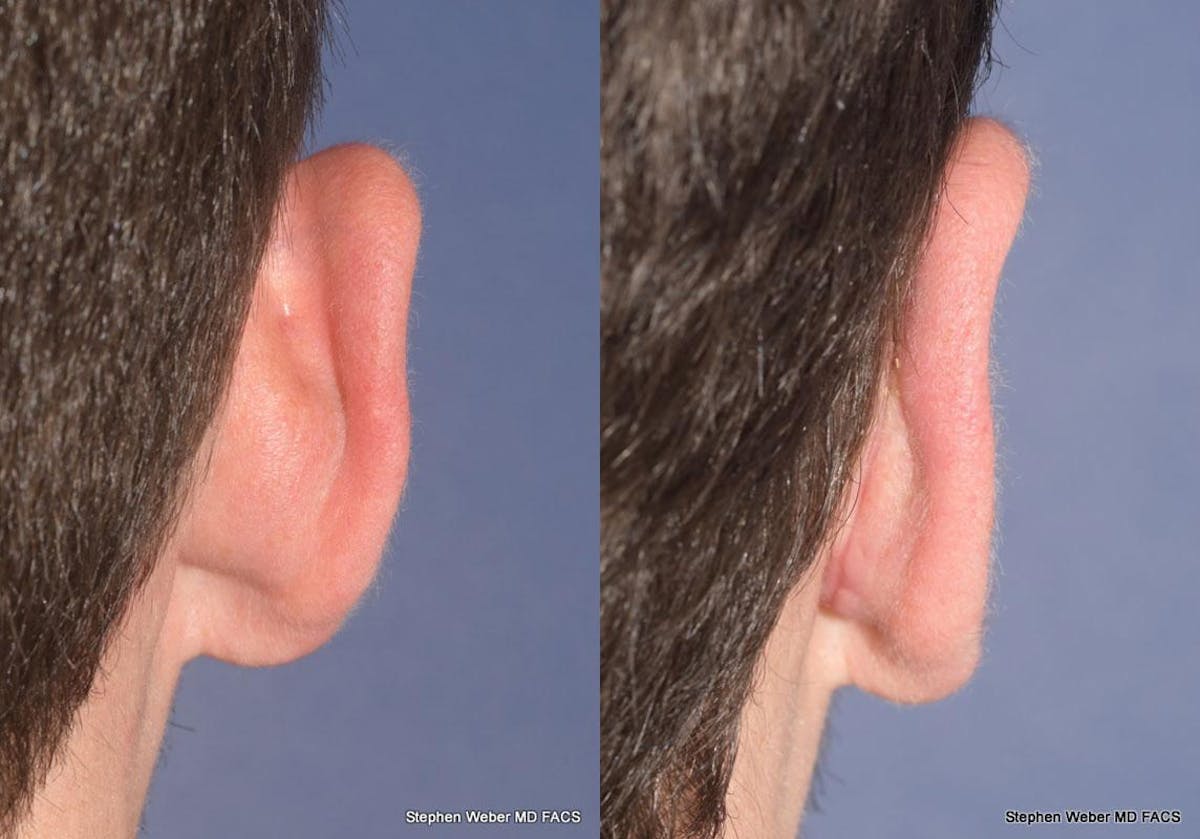 Otoplasty Before & After Gallery - Patient 344900 - Image 6