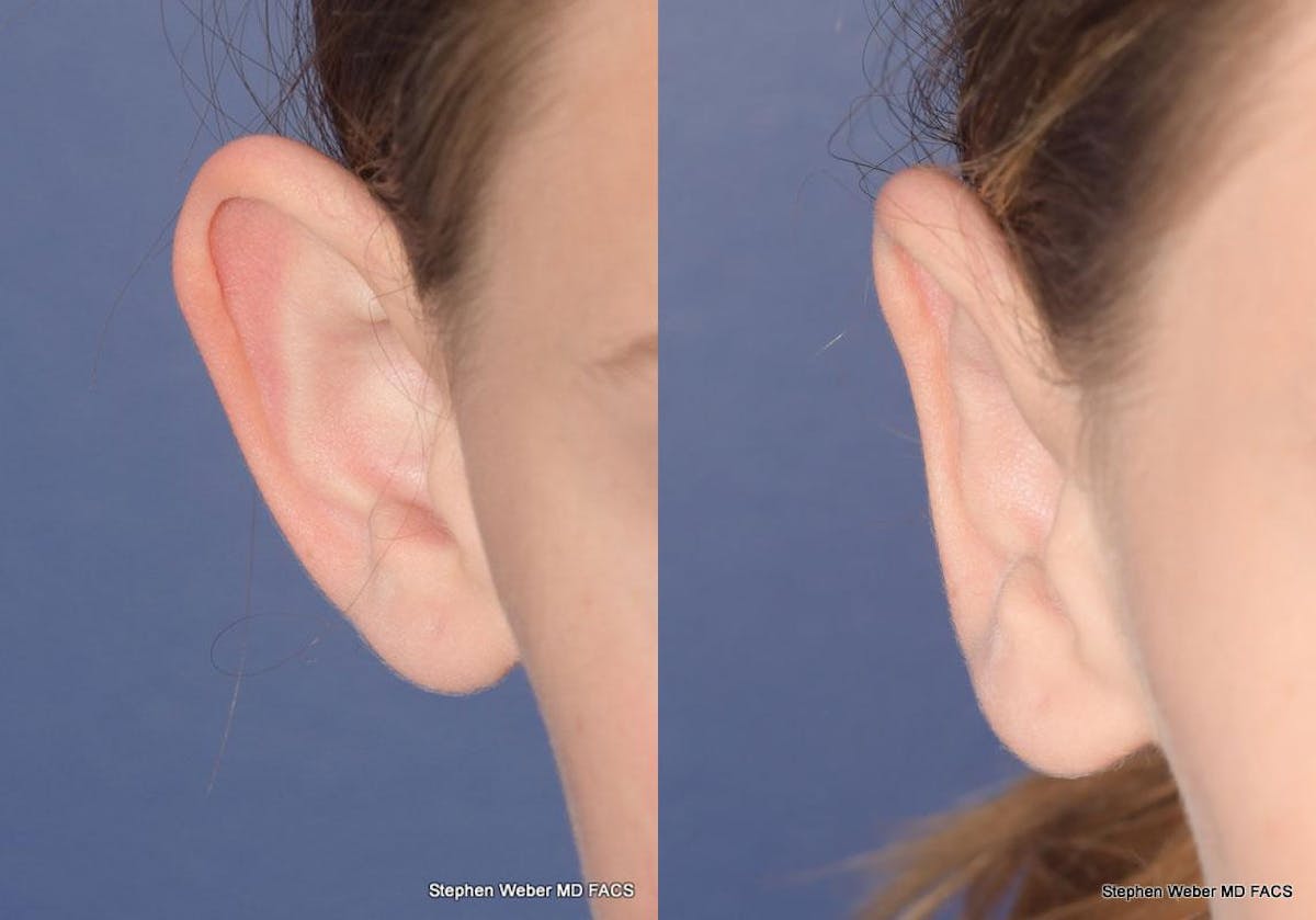 Otoplasty Before & After Gallery - Patient 361934 - Image 1