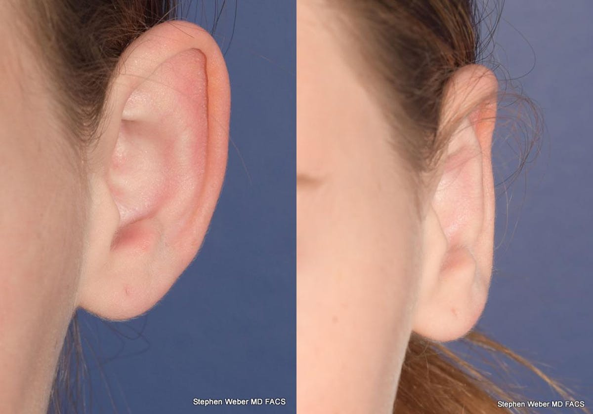 Otoplasty Before & After Gallery - Patient 361934 - Image 2