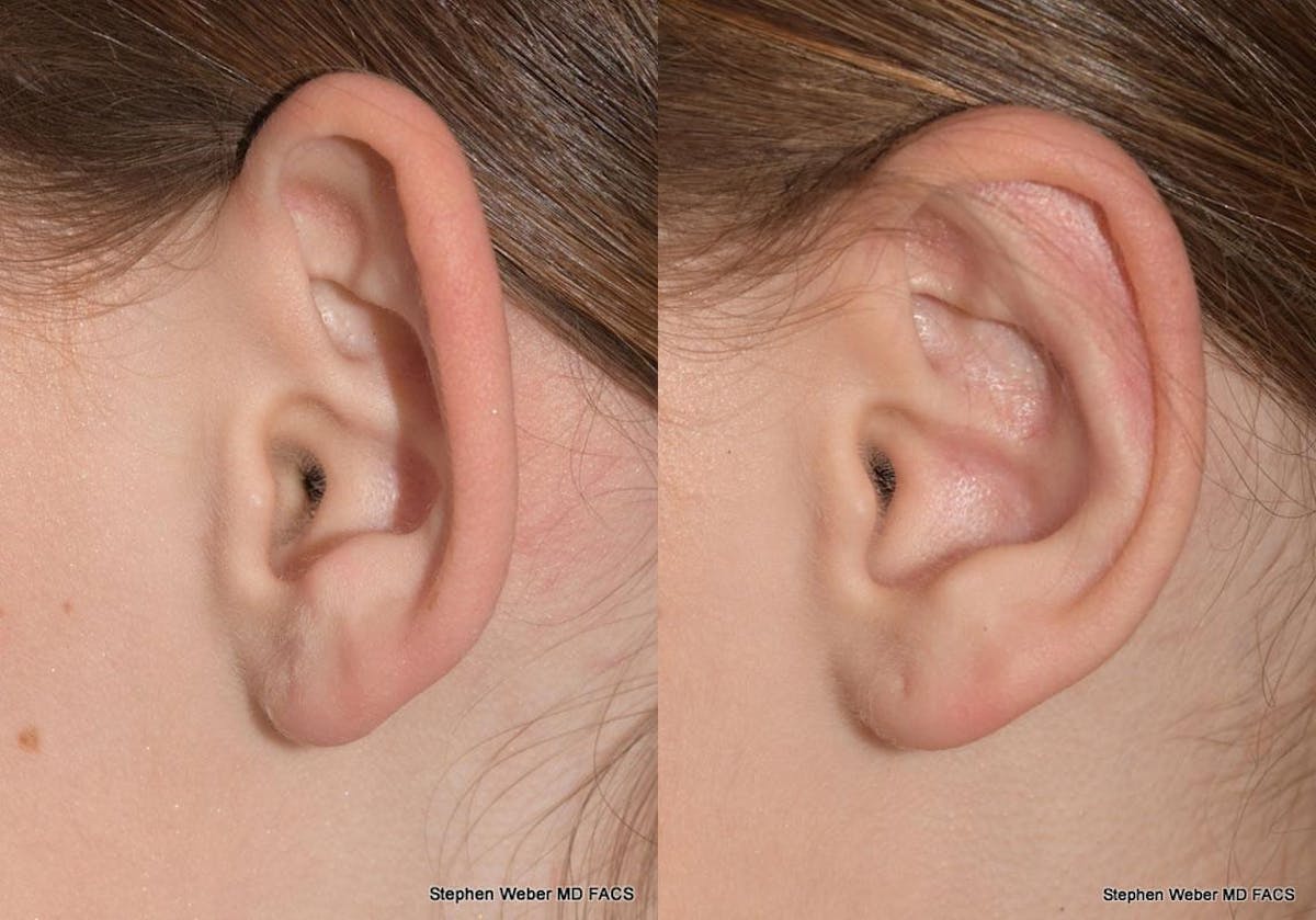 Otoplasty Before & After Gallery - Patient 361934 - Image 3
