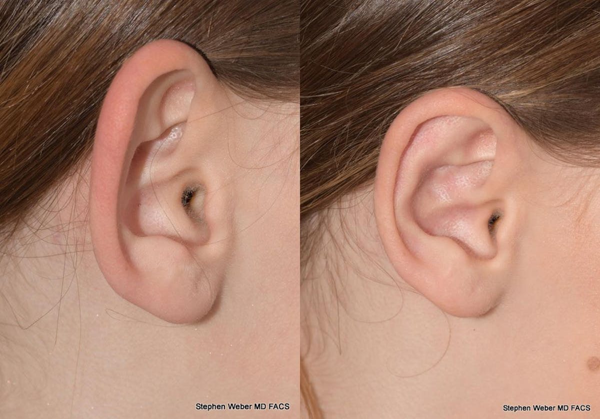Otoplasty Before & After Gallery - Patient 361934 - Image 4