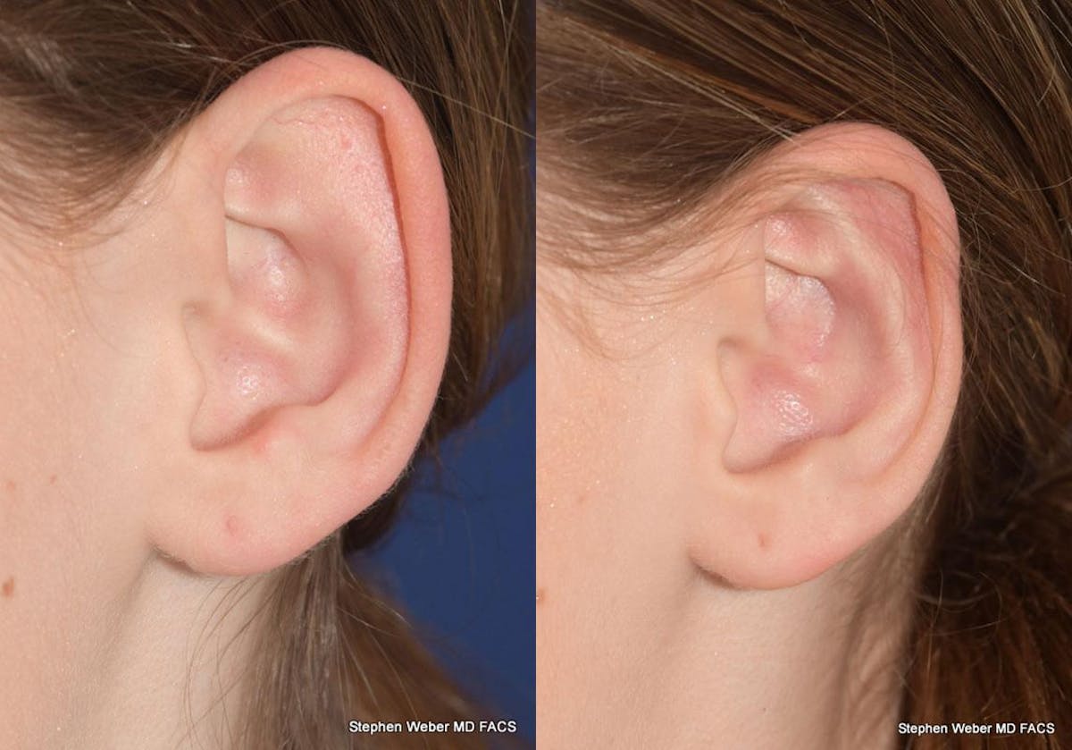 Otoplasty Before & After Gallery - Patient 361934 - Image 5