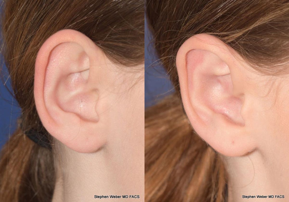 Otoplasty Before & After Gallery - Patient 361934 - Image 6