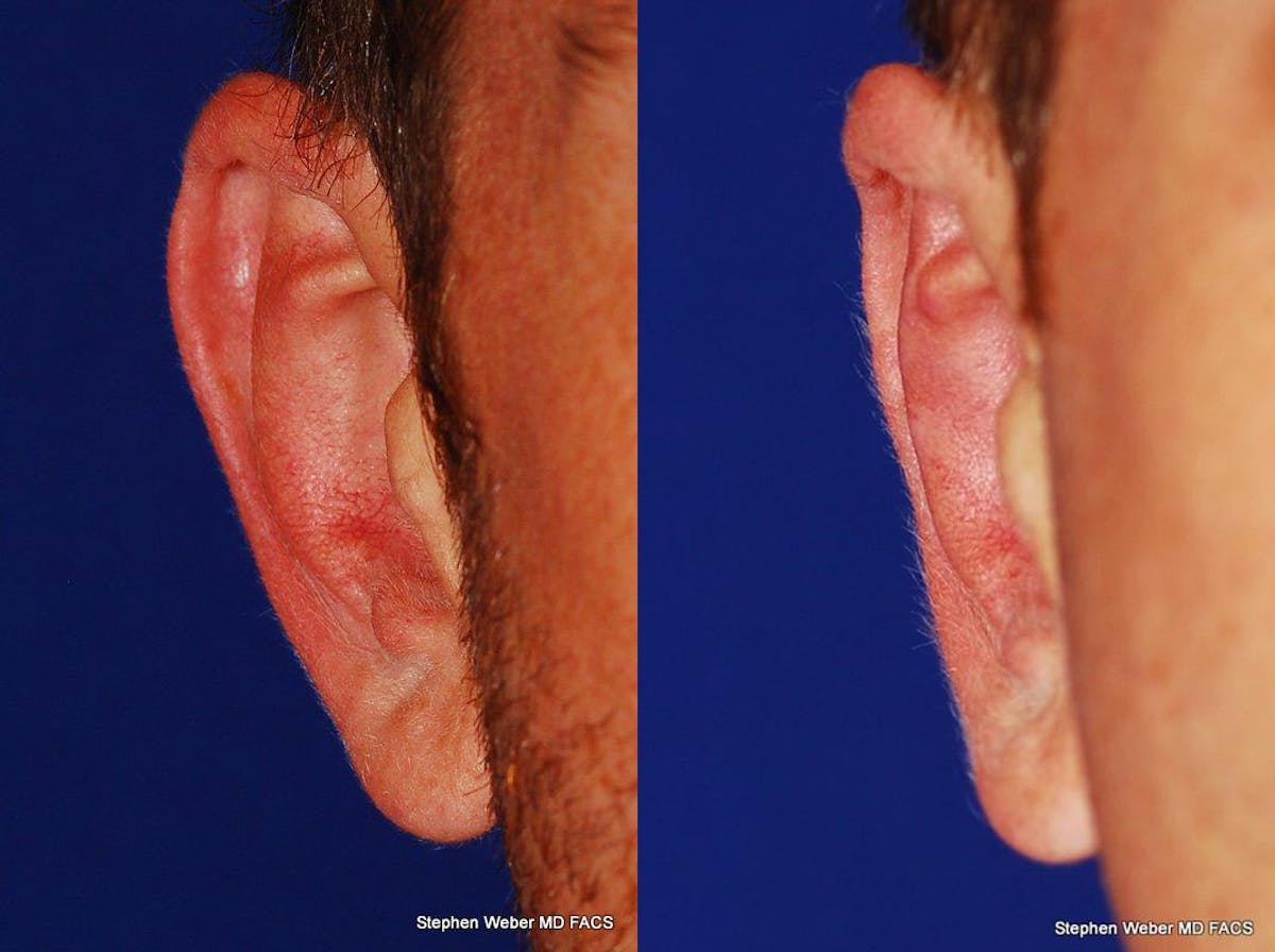 Otoplasty Before & After Gallery - Patient 310894 - Image 1