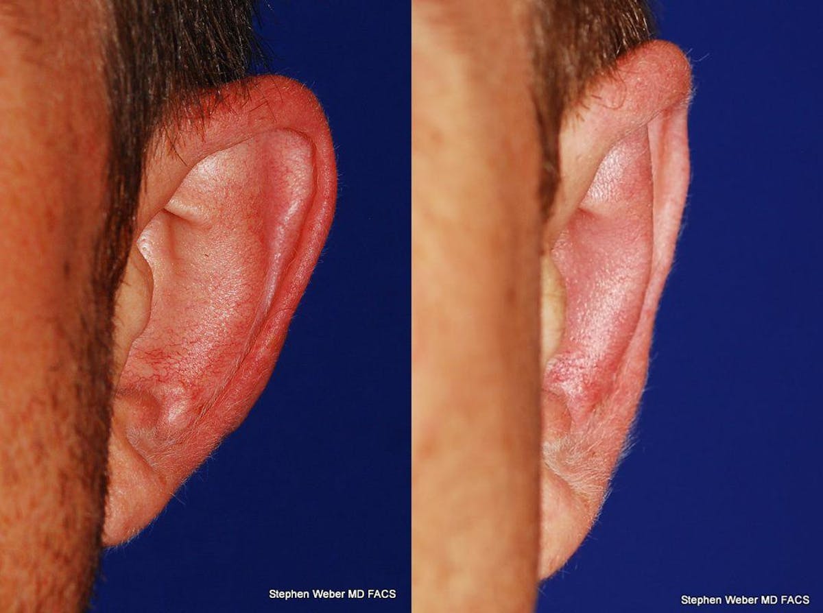 Otoplasty Before & After Gallery - Patient 310894 - Image 2