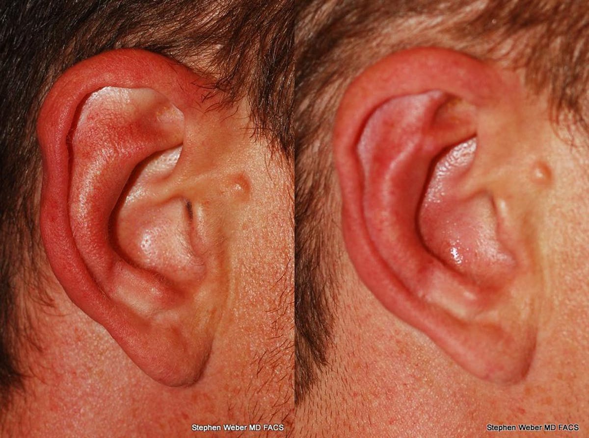 Otoplasty Before & After Gallery - Patient 310894 - Image 3