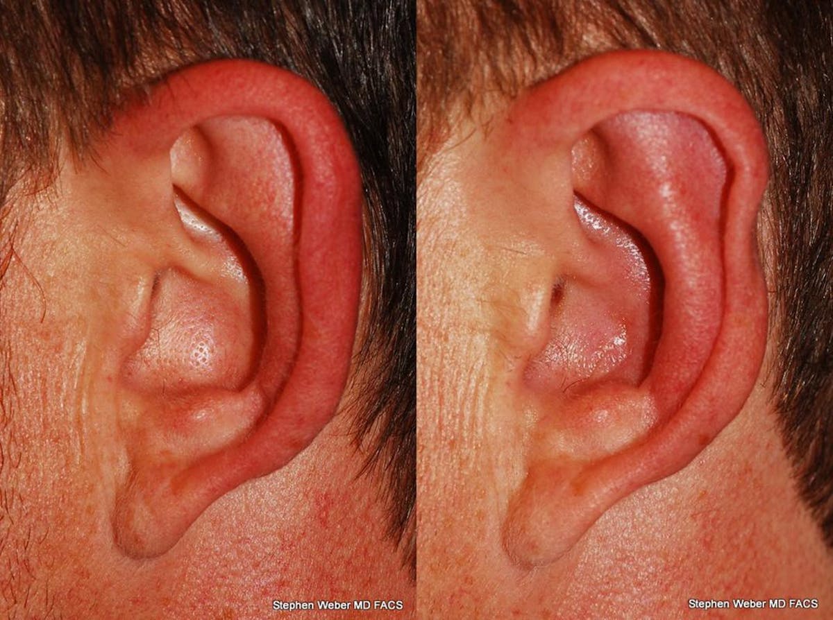 Otoplasty Before & After Gallery - Patient 310894 - Image 4