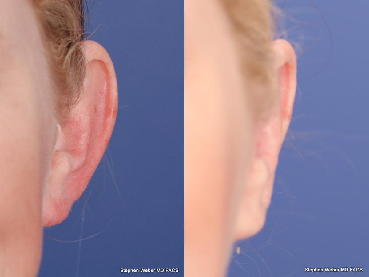 Otoplasty Before & After Gallery - Patient 233792 - Image 1
