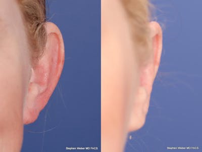 Otoplasty Before & After Gallery - Patient 233792 - Image 1
