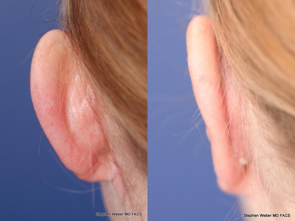 Otoplasty Before & After Gallery - Patient 233792 - Image 2