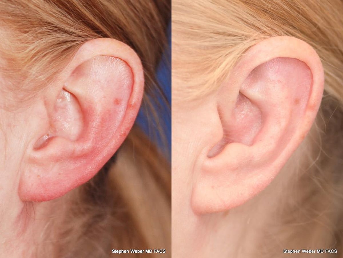 Otoplasty Before & After Gallery - Patient 233792 - Image 3