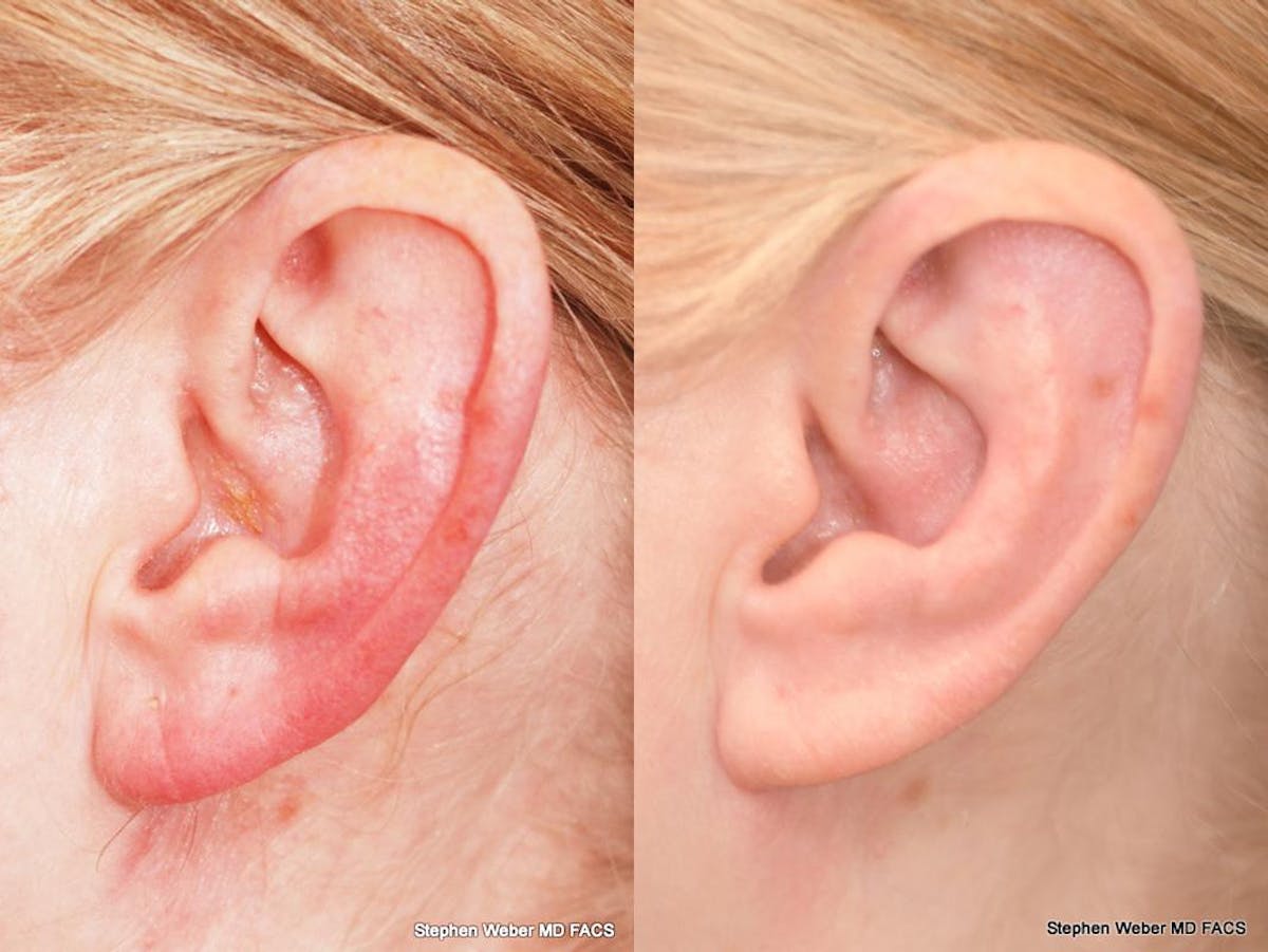 Otoplasty Before & After Gallery - Patient 233792 - Image 4