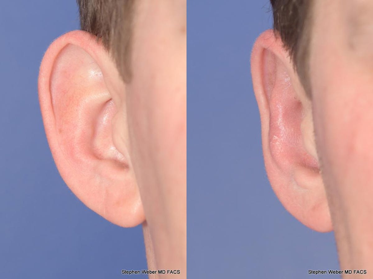 Otoplasty Before & After Gallery - Patient 344798 - Image 1