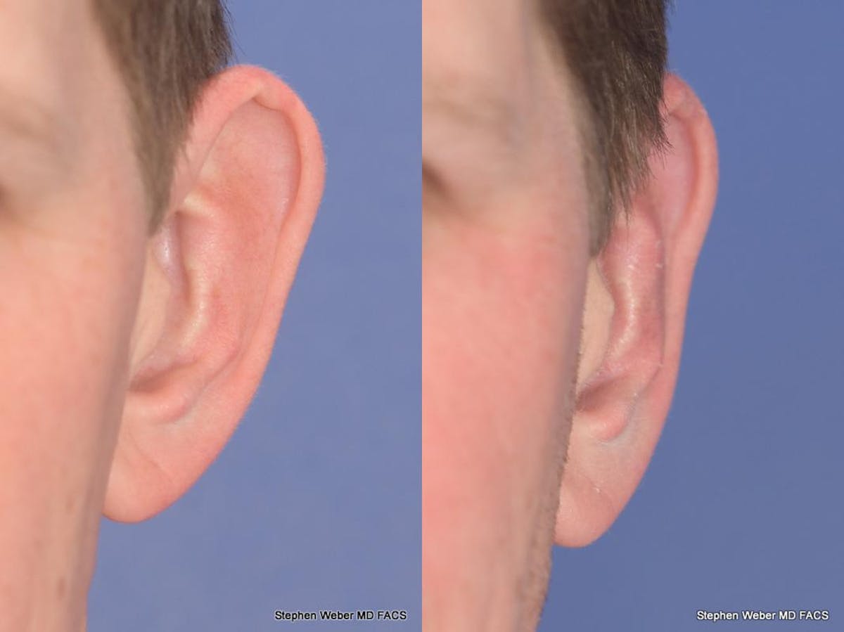 Otoplasty Before & After Gallery - Patient 344798 - Image 2