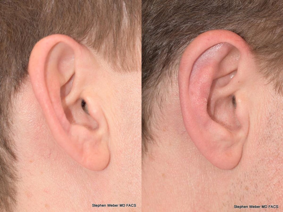 Otoplasty Before & After Gallery - Patient 344798 - Image 4