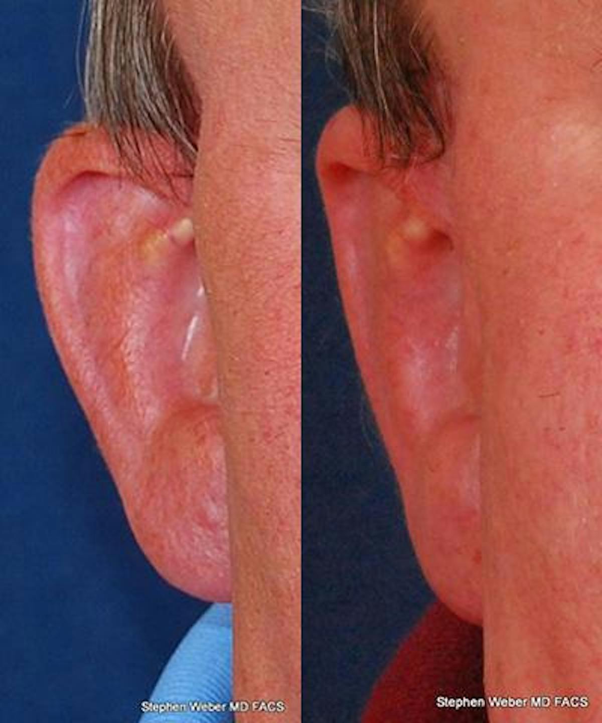 Otoplasty Before & After Gallery - Patient 985940 - Image 1