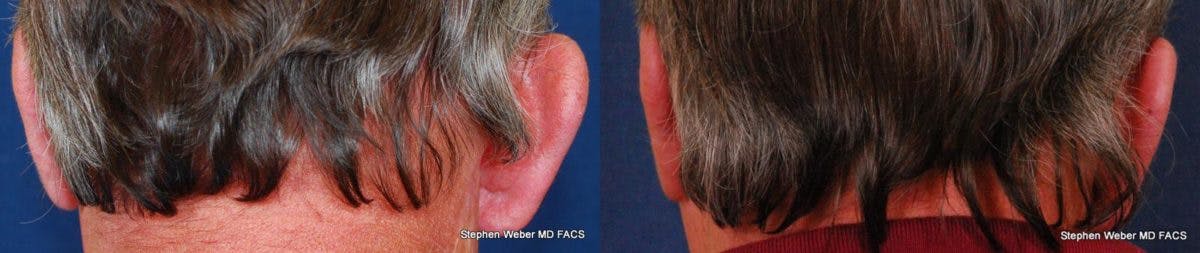 Otoplasty Before & After Gallery - Patient 985940 - Image 2