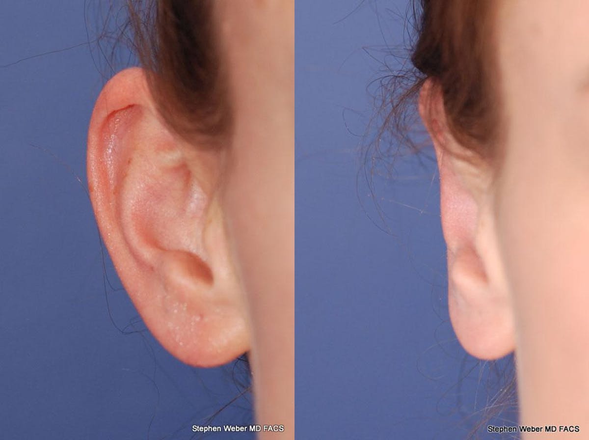 Otoplasty Before & After Gallery - Patient 258256 - Image 1