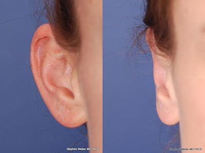 Otoplasty Before & After Gallery - Patient 258256 - Image 1