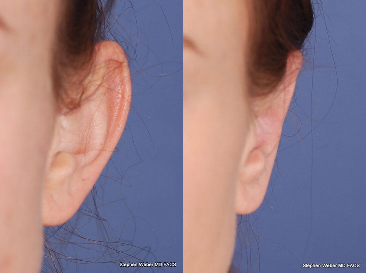 Otoplasty Before & After Gallery - Patient 258256 - Image 2
