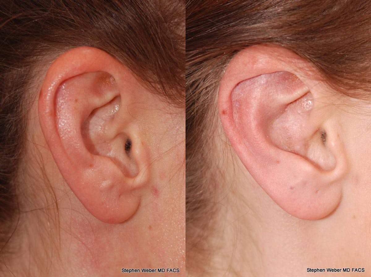 Otoplasty Before & After Gallery - Patient 258256 - Image 3