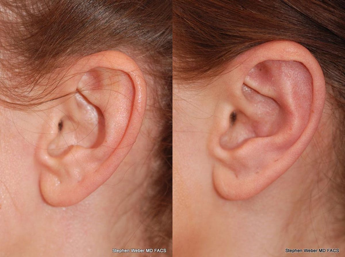 Otoplasty Before & After Gallery - Patient 258256 - Image 4