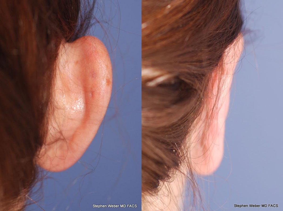 Otoplasty Before & After Gallery - Patient 258256 - Image 5