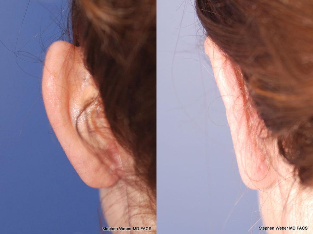 Otoplasty Before & After Gallery - Patient 258256 - Image 6