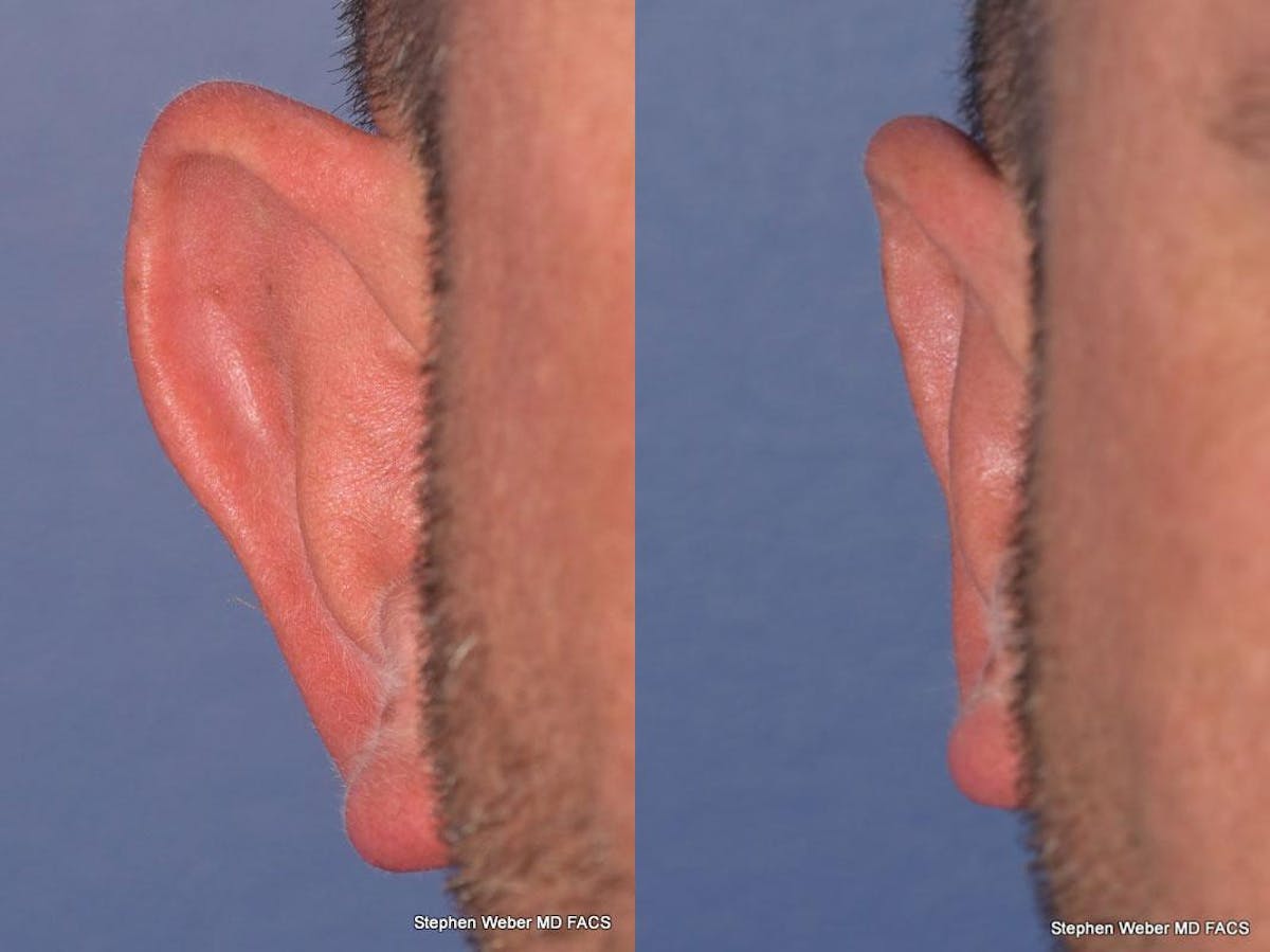 Otoplasty Before & After Gallery - Patient 429763 - Image 1