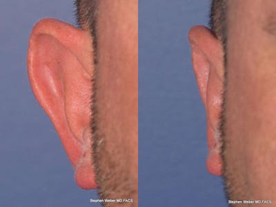 Otoplasty Before & After Gallery - Patient 429763 - Image 1