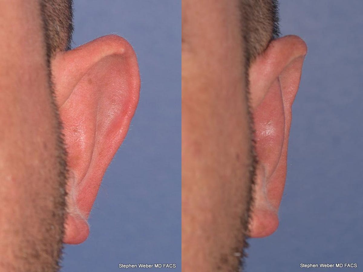 Otoplasty Before & After Gallery - Patient 429763 - Image 2