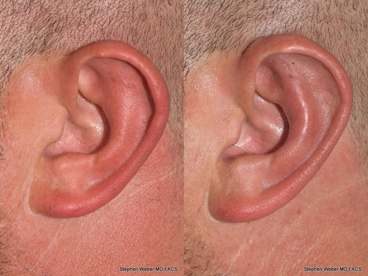 Otoplasty Before & After Gallery - Patient 429763 - Image 3