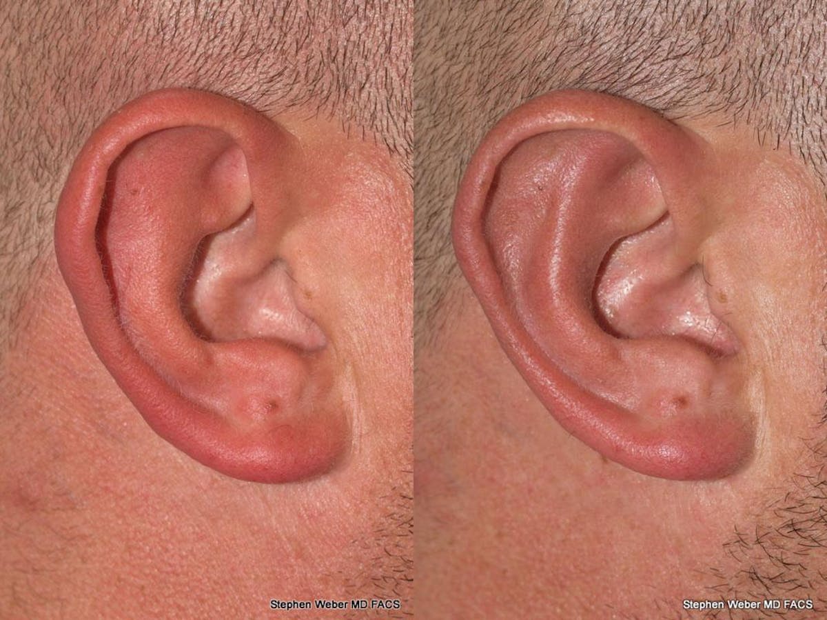 Otoplasty Before & After Gallery - Patient 429763 - Image 4