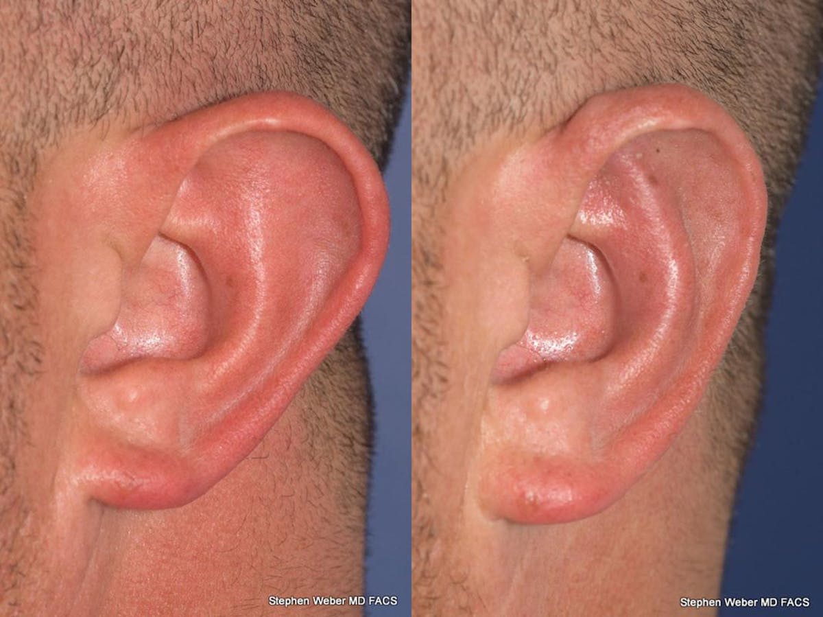 Otoplasty Before & After Gallery - Patient 429763 - Image 5