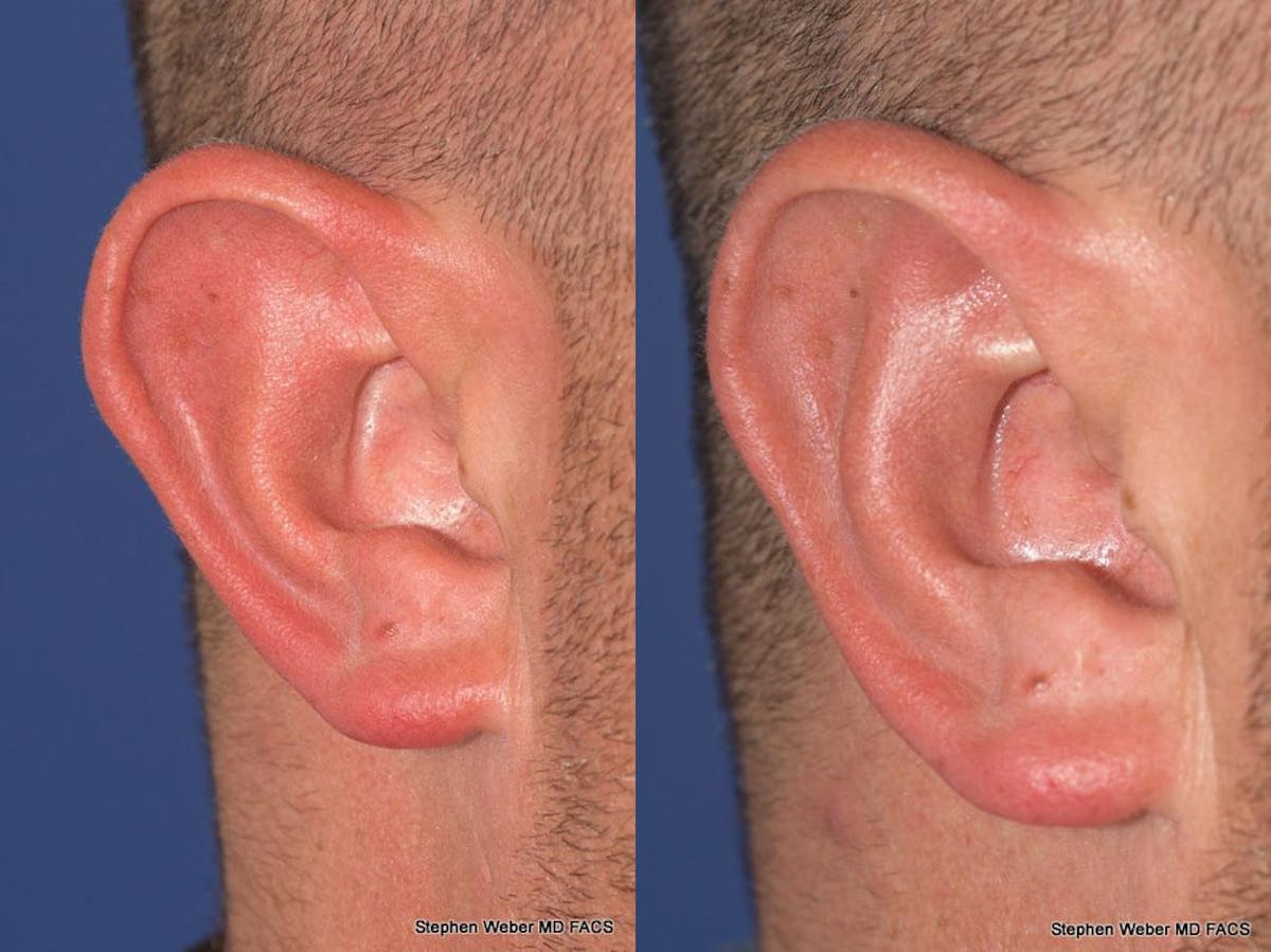 Otoplasty Before & After Gallery - Patient 429763 - Image 6