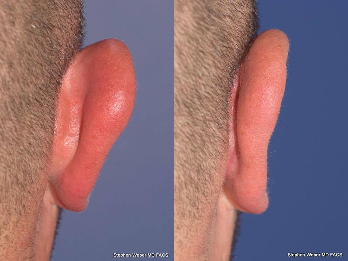 Otoplasty Before & After Gallery - Patient 429763 - Image 7
