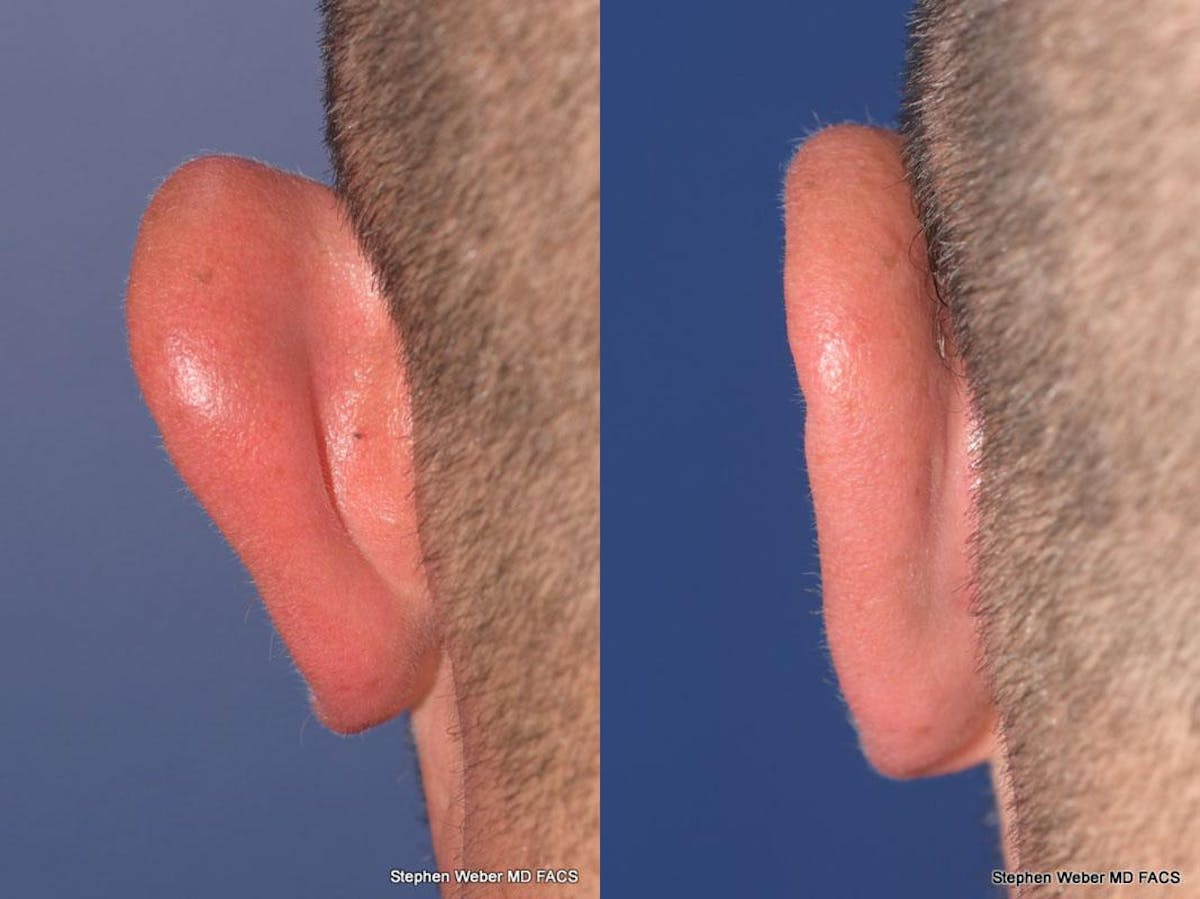 Otoplasty Before & After Gallery - Patient 429763 - Image 8