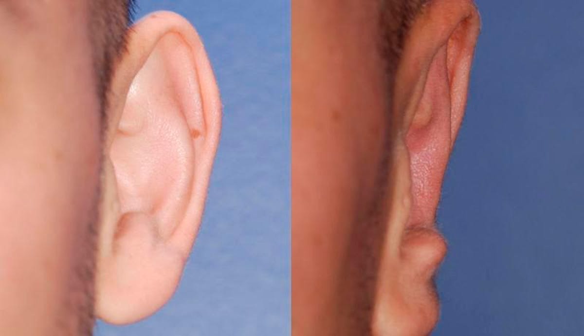 Otoplasty Before & After Gallery - Patient 160757 - Image 1