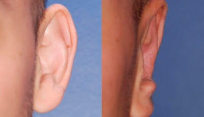 Otoplasty Before & After Gallery - Patient 160757 - Image 1