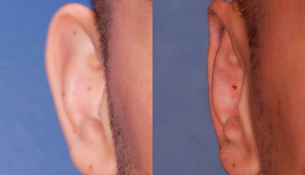 Otoplasty Before & After Gallery - Patient 160757 - Image 2