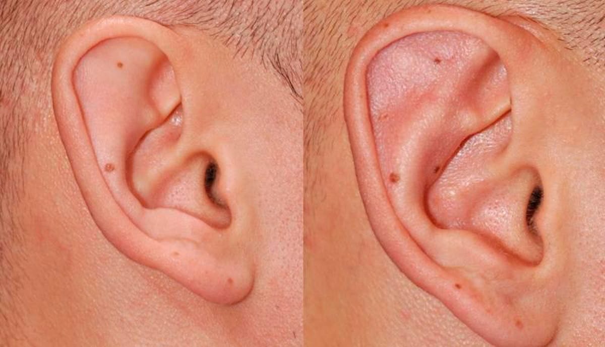 Otoplasty Before & After Gallery - Patient 160757 - Image 3