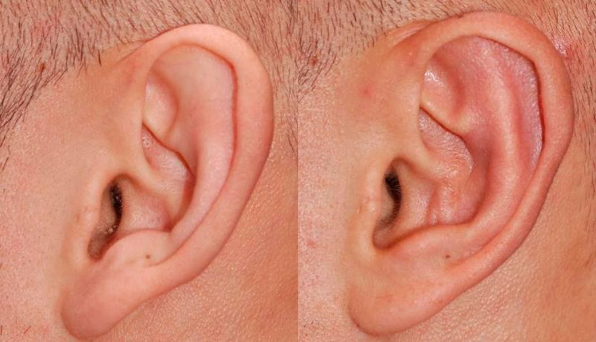 Otoplasty Before & After Gallery - Patient 160757 - Image 4