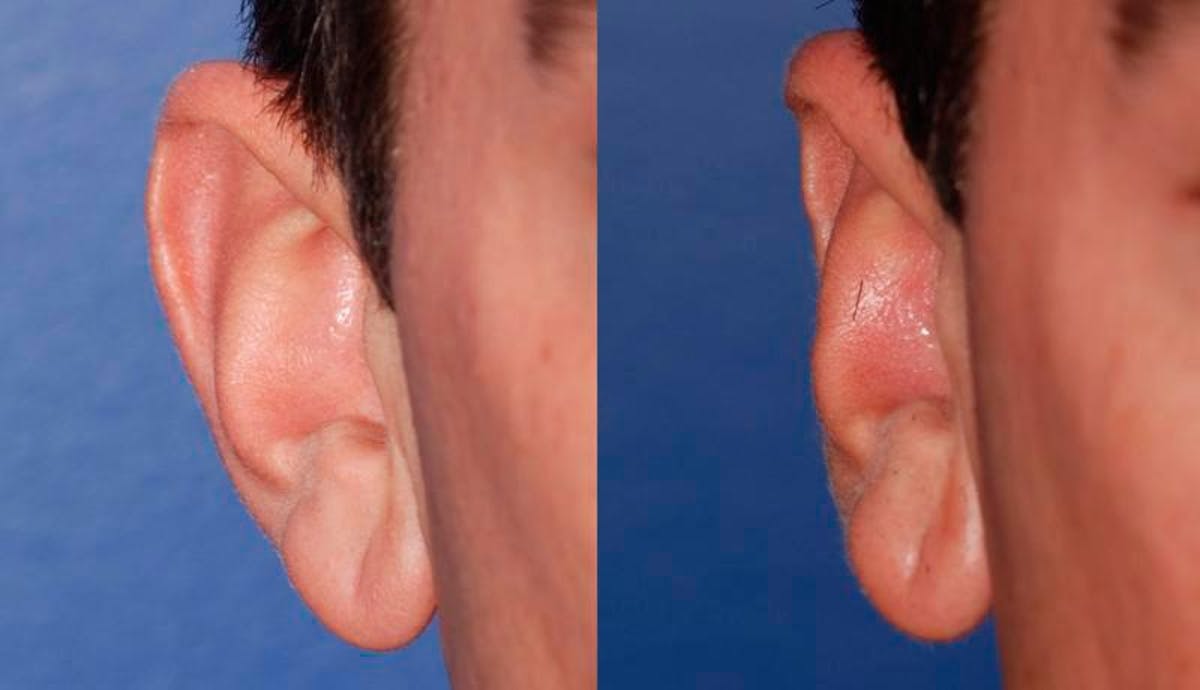 Otoplasty Before & After Gallery - Patient 203948 - Image 1