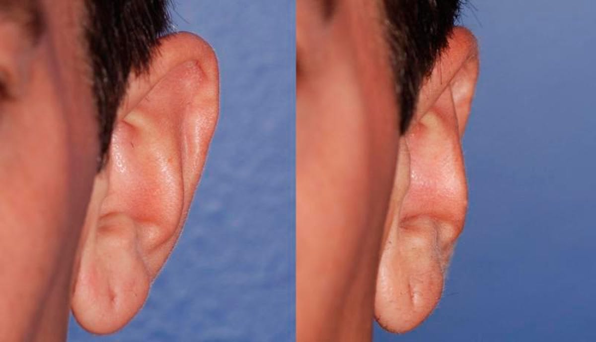 Otoplasty Before & After Gallery - Patient 203948 - Image 2
